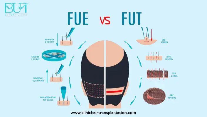 تفاوت روش کاشت مو FIT و FUT چیست